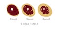 Sarcopenia in elderly. Replacement of muscle tissue