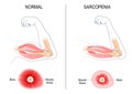 sarcopenia. muscle atrophy