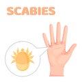 Sarcoptes scabiei. scabies. Sexually transmitted disease. Infographics. illustration on isolated background.