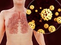 Sars disease, coronaviruses in the lung