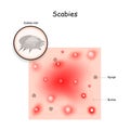 Scabies. contagious skin infestation Royalty Free Stock Photo