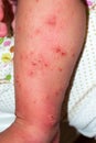 Scabies skin lesions