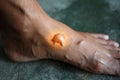 The scald on the foot skin caused
