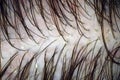 Scalp and hair with multiple exfoliation. Macroscopy of hair on the head with signs of peeling at hair follicles. Royalty Free Stock Photo