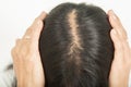 Scalp and thin hair, hair removal Royalty Free Stock Photo