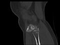 scan knee Fracture of intercondylar eminence of tibia. Compression fracture of posterior of lateral tibial plateau which involv