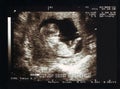 Scan on pregnancy, foetus Royalty Free Stock Photo