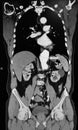 Scan tomography thoracic aorta aneurism