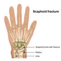 Scaphoid bone fracture medical illustration on white background