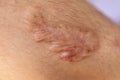 A scar is an area of fibrous tissue that replaces normal skin after an injury.