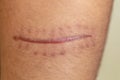 A scar of fibrous tissue that replaces normal skin after an injury on skin.