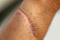 A scar of fibrous tissue that replaces normal skin after an injury on skin. Royalty Free Stock Photo