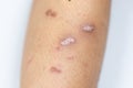 A scar is an area of fibrous tissue that replaces normal skin after an injury.