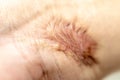 A scar is an area of fibrous tissue that replaces normal skin after an injury. Royalty Free Stock Photo