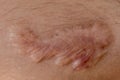 A scar is an area of fibrous tissue that replaces normal skin after an injury. Royalty Free Stock Photo