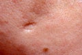 Scar after big pimple on human skin