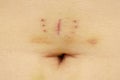 Scar with bruise and belly button closeup after hysterectomy Royalty Free Stock Photo