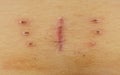 Scar with bruise closeup after hysterectomy Royalty Free Stock Photo