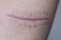 A scar of fibrous tissue that replaces normal skin after an injury on skin.