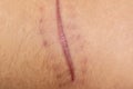 A scar of fibrous tissue that replaces normal skin after an injury on skin.