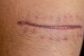 A scar of fibrous tissue that replaces normal skin after an injury on skin.