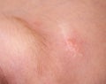 Scar on the forehead on the skin of a child, macro. Medical, laser scar resurfacing