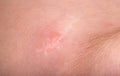 Scar on the forehead on the skin of a child, macro. Medical, laser scar resurfacing