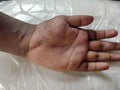 Scar on a hand after injury