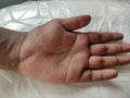 Scar on a hand after injury