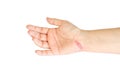 scar on hand on white background