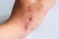 The scar on his arm near the wrist on a white background. Two scars next to each other on the arm, close-up. Not isolated