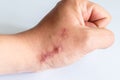 The scar on his arm near the wrist on a white background. Two scars next to each other on the arm, close-up. Not isolated