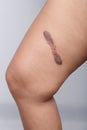 Scar on human skin