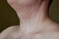 Scar on the neck of a man after removal of the thyroid gland Royalty Free Stock Photo