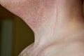 Scar on the neck of a man after removal of the thyroid gland Royalty Free Stock Photo