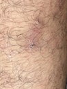 Scar on skin. The wound form scabs on leg. Man with long scab wound on right leg.