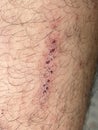 Scar on skin. The wound form scabs on leg. Man with long scab wound on right leg.