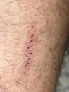 Scar on skin. The wound form scabs on leg. Man with long scab wound on right leg.