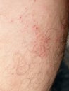 Scar on skin. The wound form scabs on leg. Man with long scab wound on right leg.