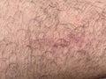 Scar on skin. The wound form scabs on leg. Man with long scab wound on right leg.