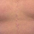 Scar from surgery