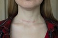 scar after surgery on woman neck