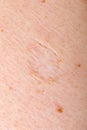 Scar tissue on human skin Royalty Free Stock Photo