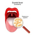 Scarlet fever. Close-up of colony of Streptococcus