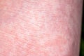 Scarlet Fever starts with a red rush and the strawberry tongue Afterwards the affected skin often peels - Here red skin