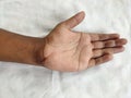 Scarred hand injury on wrist
