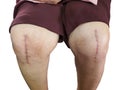 Scarring from osteoarthritis treatment by joint replacement surgery. Royalty Free Stock Photo