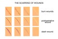 The scarring of wounds Royalty Free Stock Photo