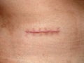 Scars from appendectomy