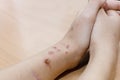 Scars from cuts and burns on the arm Royalty Free Stock Photo